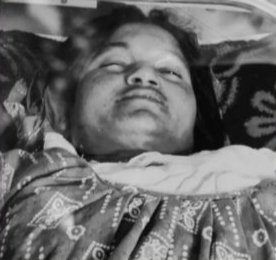 Chaibasa News: अलाव तापते समय साड़ी में लगी आग, पांच माह पहले शादी हुई महिला की दर्दनाक मौत अलाव से झुलसी